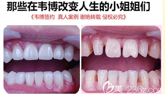 深圳韋博口腔牙齒貼面效果圖 深圳韋博口腔牙齒貼面效果圖