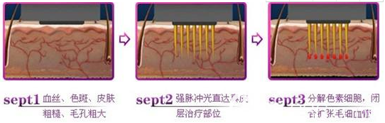 紅血絲的治療過(guò)程 紅血絲的治療過(guò)程