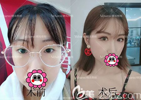 嘉興曙光為我做的雙眼皮+開(kāi)內(nèi)眼角術(shù)后恢復(fù)45天實(shí)現(xiàn)我的網(wǎng)紅眼夢(mèng)想