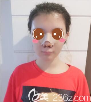 <!--<i data=20240703-sp></i>-->華美謝衛(wèi)國假體隆鼻真人案例術(shù)后第7天