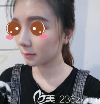 <!--<i data=20240703-sp></i>-->華美謝衛(wèi)國假體隆鼻真人案例術(shù)后21天