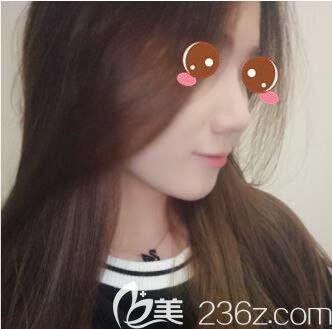 還在擔(dān)心做隆鼻后不能摳鼻子嗎？謝衛(wèi)國為我做假體隆鼻術(shù)后就沒有這樣顧慮