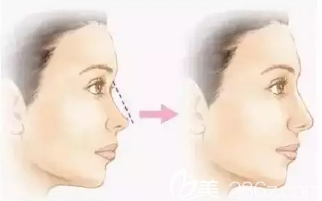線雕隆鼻術(shù)后效果對比