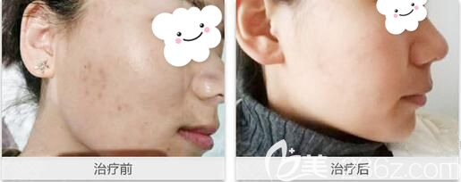 彭靜醫(yī)生做彩光祛斑術(shù)前術(shù)后對比
