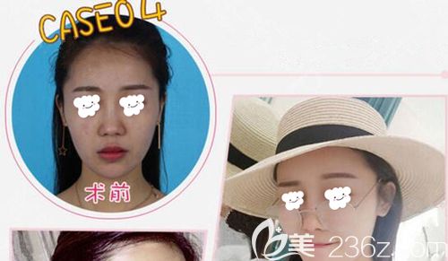 馬永奎做真人案例術(shù)后3月面部飽滿