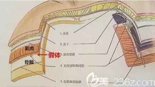 假體植入下巴的部位
