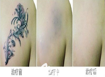 紋繡術前和術后的圖片