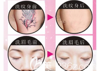 激光洗眉和洗紋身對比照
