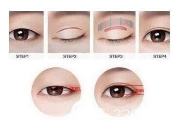 割雙眼皮的手術(shù)過程示意圖