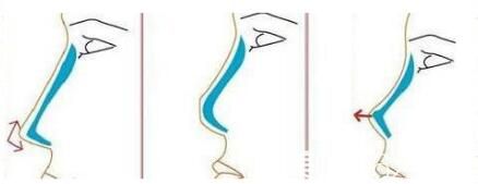 隆鼻材料硅膠和膨體那個更好