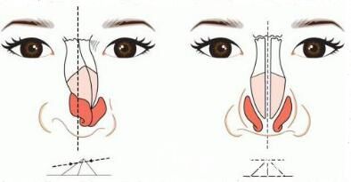 硅膠和膨體那個隆鼻材料能夠更好一點