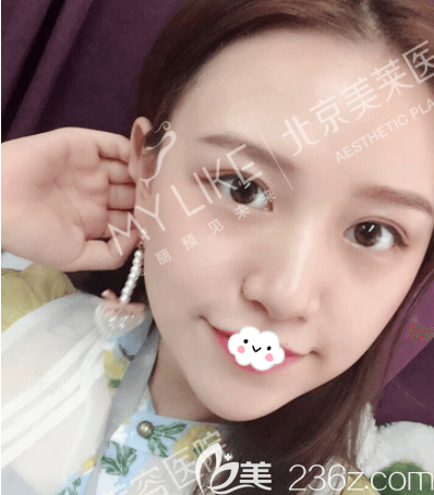 周福田醫(yī)生給我做玻尿酸墊下巴第7天效果 周福田醫(yī)生給我做玻尿酸墊下巴第7天效果