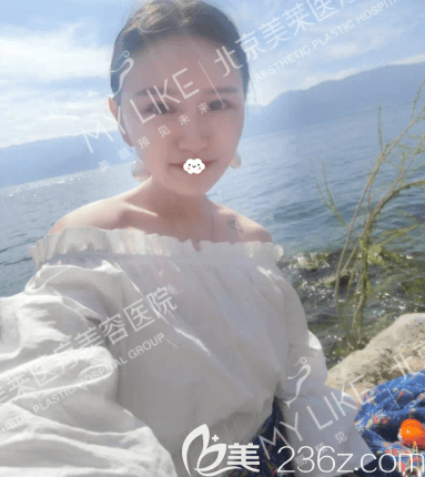 北京美萊周福田玻尿酸墊下巴案例 北京美萊周福田玻尿酸墊下巴案例