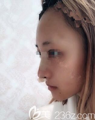 做完自體耳軟骨鼻綜合術(shù)后效果