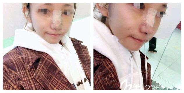 術(shù)后五天到南京韓辰復(fù)查自體軟骨隆鼻恢復(fù)