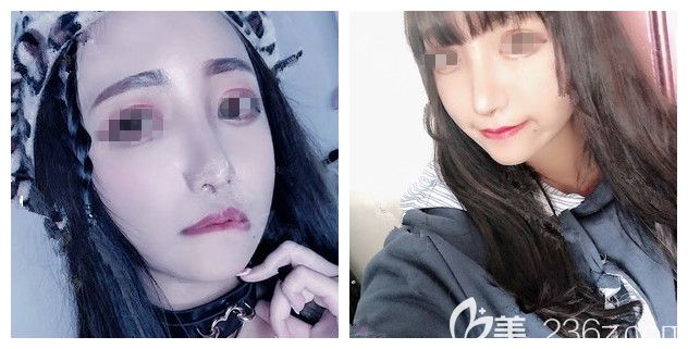 得到取耳軟骨對耳朵不會有傷害的肯定答案后，在南京韓辰做了鼻小柱切口的自體耳軟骨鼻綜合整形