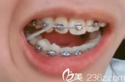 我在北京維嘉口腔做牙齒矯正1年效果