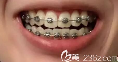 我在北京維嘉口腔戴金屬托槽1年半