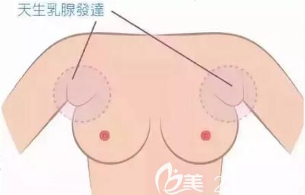 副乳的危害