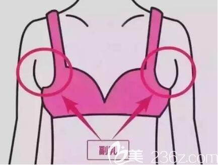 副乳還存在哪些危害呢？