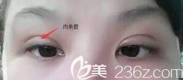 割雙眼皮術(shù)后出現(xiàn)肉條怎么辦？