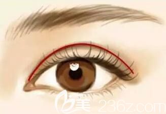 割雙眼皮術(shù)后出現(xiàn)肉條進(jìn)行修復(fù)手術(shù)