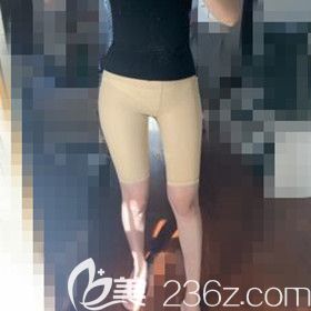 吸脂瘦大腿術(shù)后3天