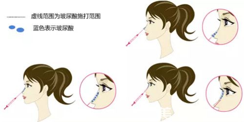 注射玻尿酸隆鼻過(guò)程