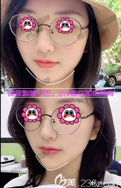 鄭州菲林做玻尿酸豐下巴的前后對(duì)比 鄭州菲林做玻尿酸豐下巴的前后對(duì)比