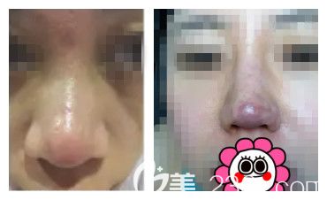 注射玻尿酸隆鼻術(shù)后出現(xiàn)鼻頭有紅疙瘩的表現(xiàn)