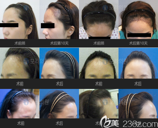 毛理醫(yī)院植發(fā)<span style=