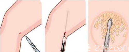 大腿吸脂手術(shù)過程圖