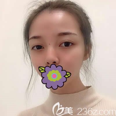 瞧！我在福州瑪恩找陳意蕾做完激光祛斑后收獲了一個全新的自己