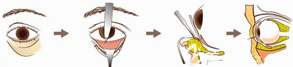 激光祛眼袋過程圖