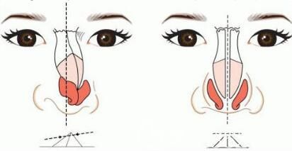 硅膠假體會危害健康嗎？