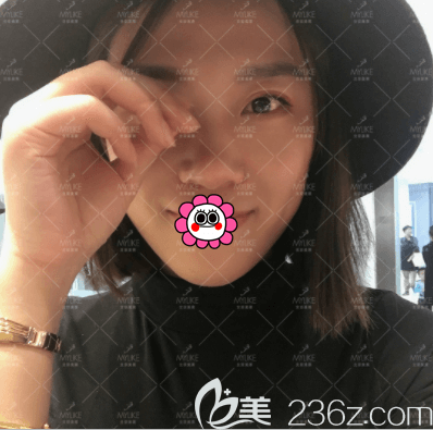 北京美萊玻尿酸豐蘋果肌案例 北京美萊玻尿酸豐蘋果肌案例