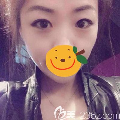 駐馬店金玄宮眼綜合術(shù)前眼睛內(nèi)雙 駐馬店金玄宮眼綜合術(shù)前眼睛內(nèi)雙