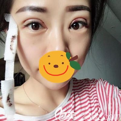 駐馬店金玄宮眼綜合術(shù)后24小時(shí) 駐馬店金玄宮眼綜合術(shù)后24小時(shí)