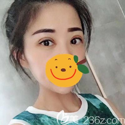 駐馬店金玄宮眼綜合術(shù)后第10天 駐馬店金玄宮眼綜合術(shù)后第10天