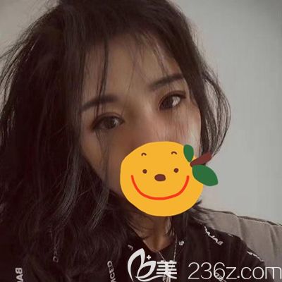 駐馬店金玄宮眼綜合術(shù)后45天 駐馬店金玄宮眼綜合術(shù)后45天