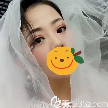 經(jīng)過(guò)了一場(chǎng)在駐馬店的眼部綜合手術(shù) 一個(gè)月后我的內(nèi)雙大小眼得到拯救