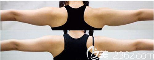 做手臂抽脂術前術后對比效果