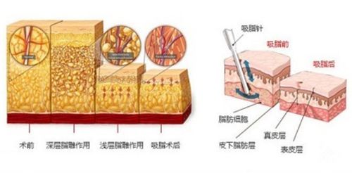 手臂吸脂減肥的手術步驟原理圖