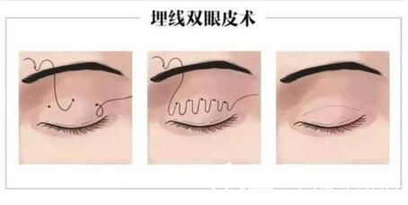 埋線雙眼皮手術(shù)過程示意圖