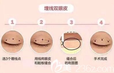 埋線雙眼皮的詳細介紹