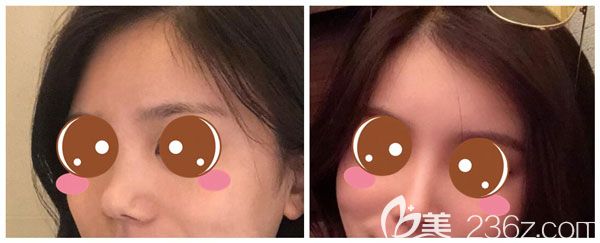 假體隆鼻+自體耳軟骨墊鼻尖+鼻翼縮小案例