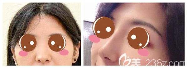 耳軟骨墊鼻尖+膨體隆鼻案例效果對(duì)比圖