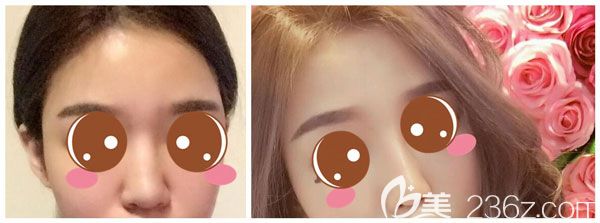 肋軟骨隆鼻+耳軟骨墊鼻尖真人案例