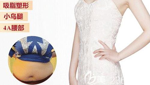 腰腹吸脂術后52天恢復效果變A4腰