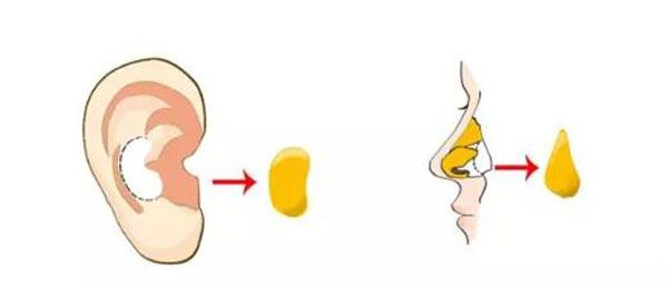 自體耳軟骨隆鼻